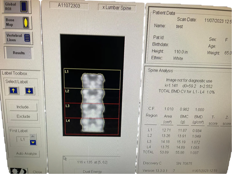 HOLOGIC Discovery QDR series 2012 DEXA Bone Densitometer